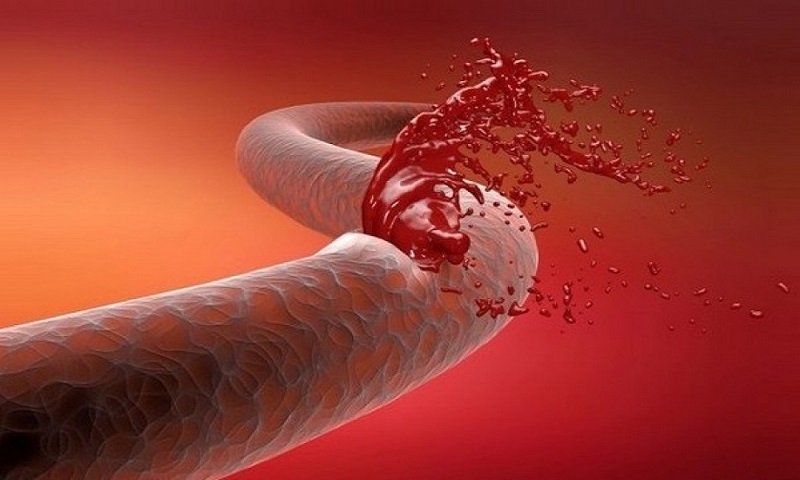 علائم خون‌ریزی داخلی بدن چیست
