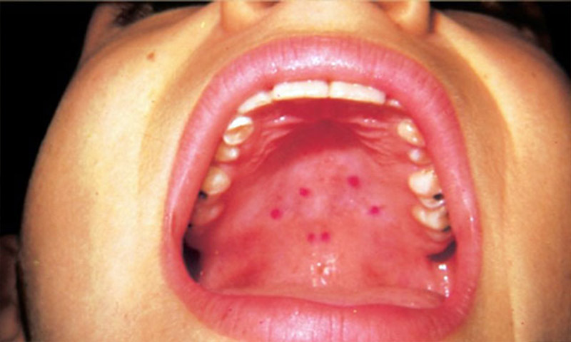 زخم های دهان را جدی بگیرید/شایع ترین علامت سرطان زبان را بشناسید