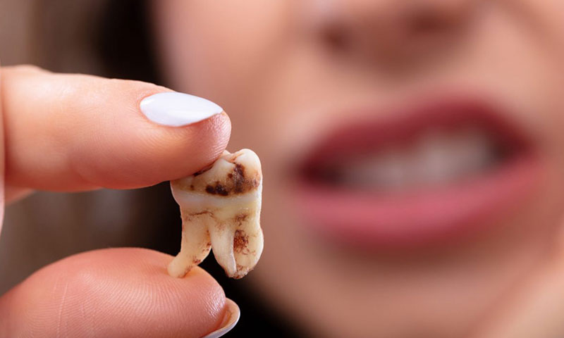 بررسی علل پوسیدگی دندان های کودکان