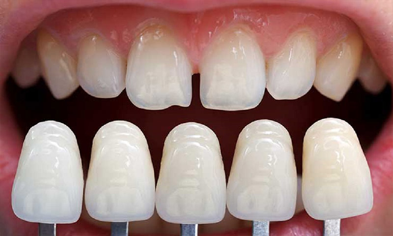 رایج ترین و بهترین روش های زیبایی دندان کدامند؟